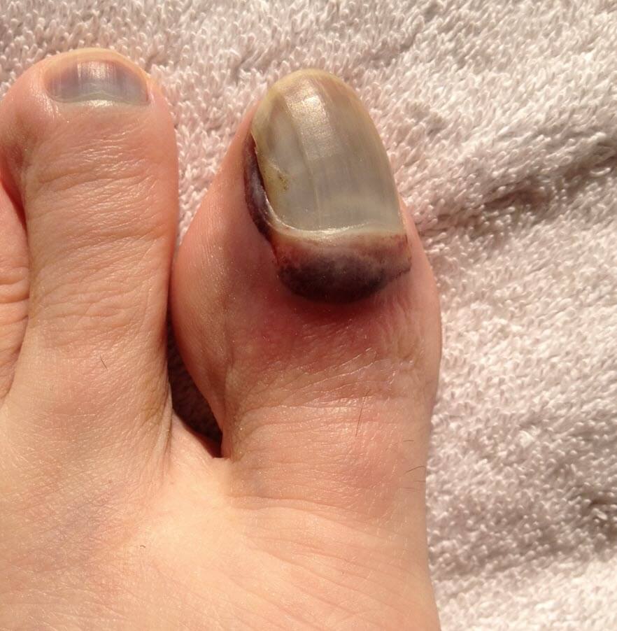 toanil blisters big toe blood blister