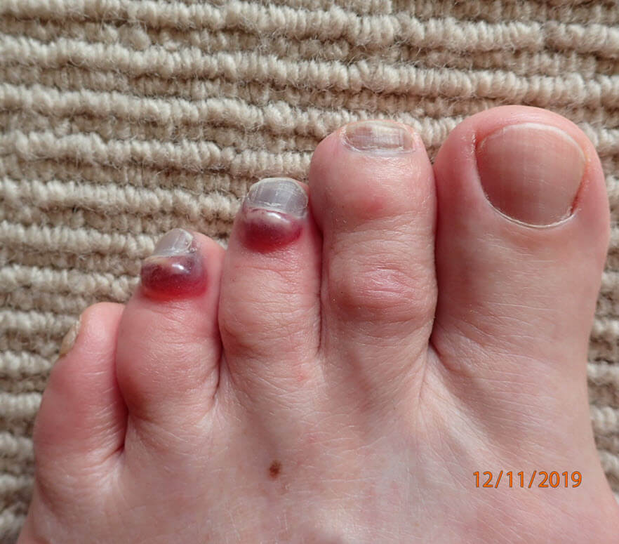 blisters under toenails