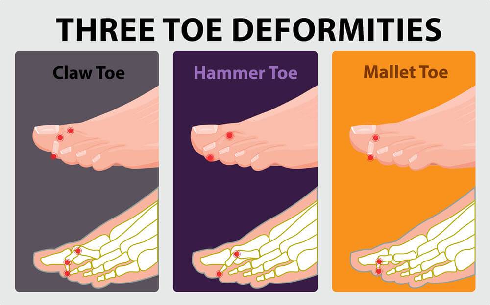 three toe deformities - claw toe, hammertoe and mallet toe