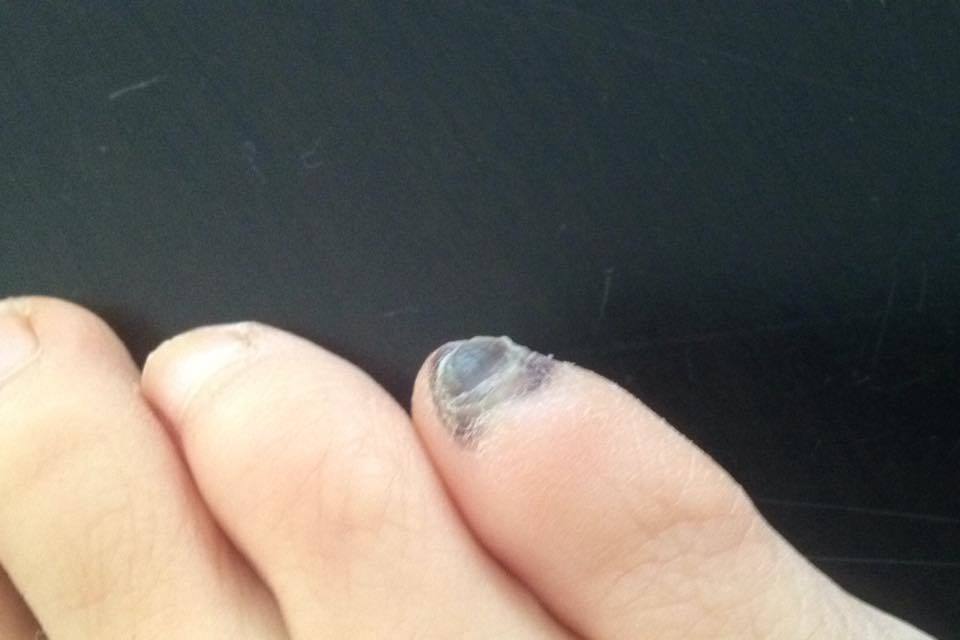 Black nail of little toe