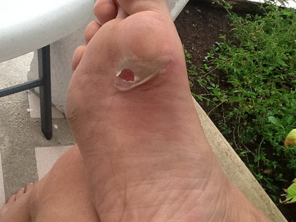 Torn blister: Your main aim is to prevent infection now the blister is open.