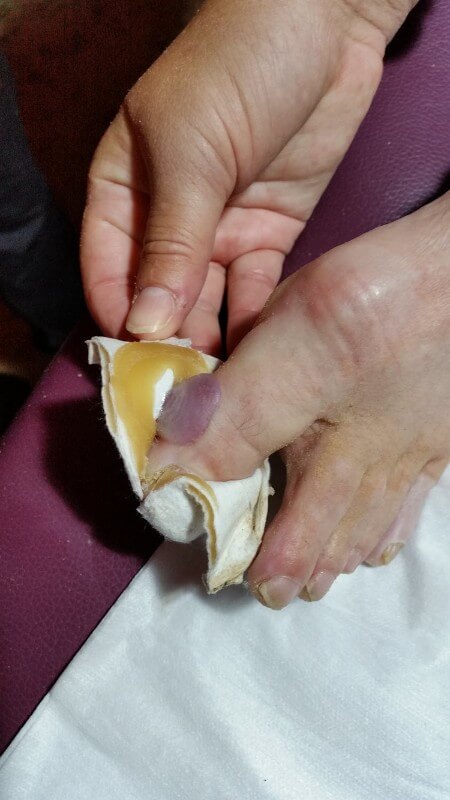 Big toe blood blister