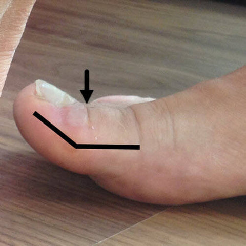 Big toe cocked-up can cause toenail blisters of the big toe