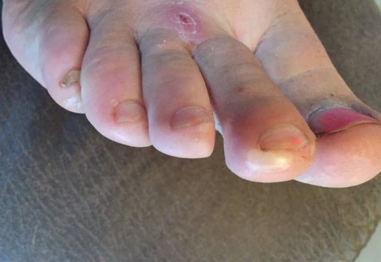 second toe blister