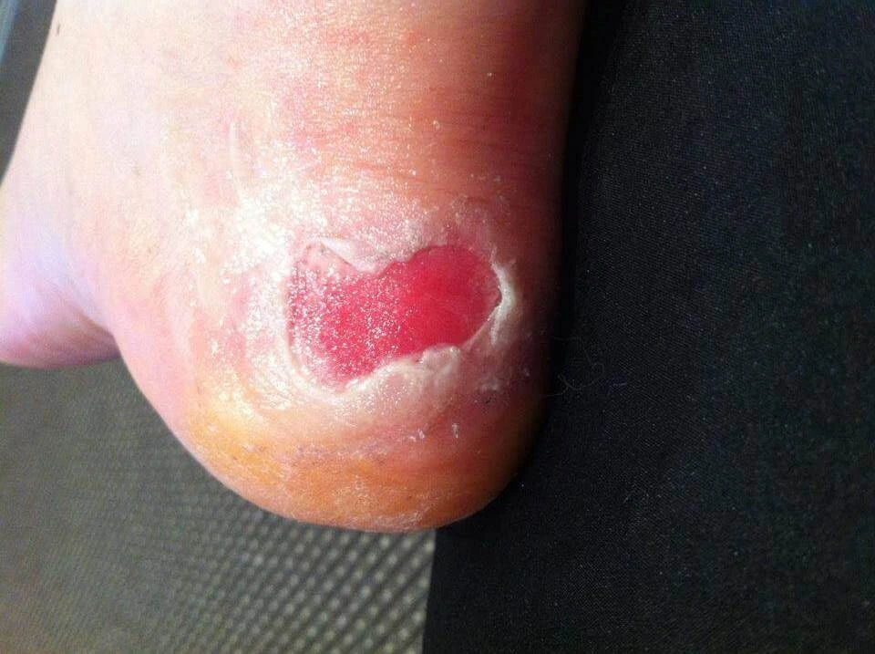 worst blister on heel