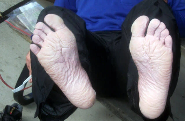 preventing skin maceration on feet