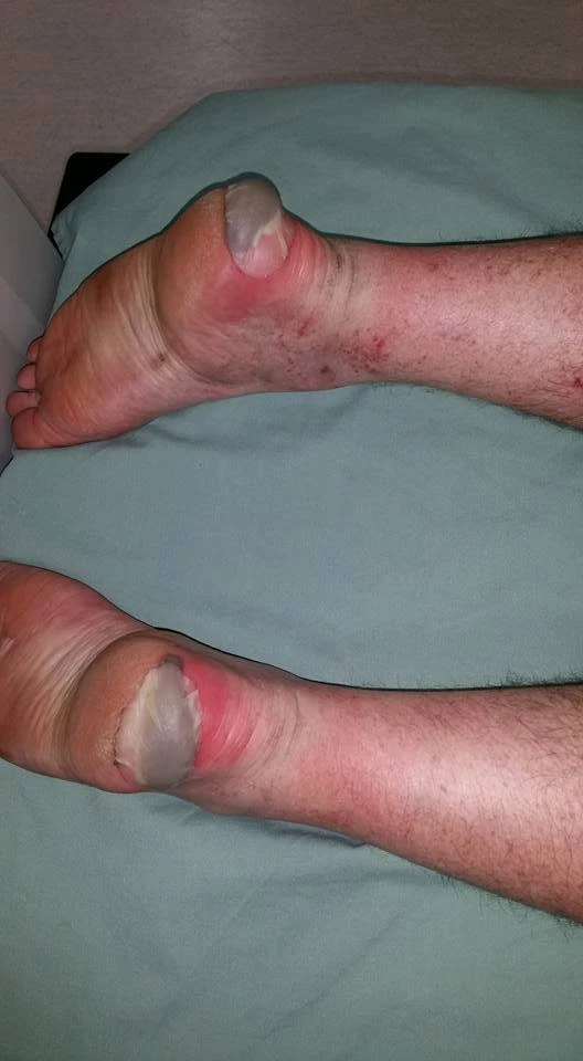 Your worst blister experience: heel edge blood blisters