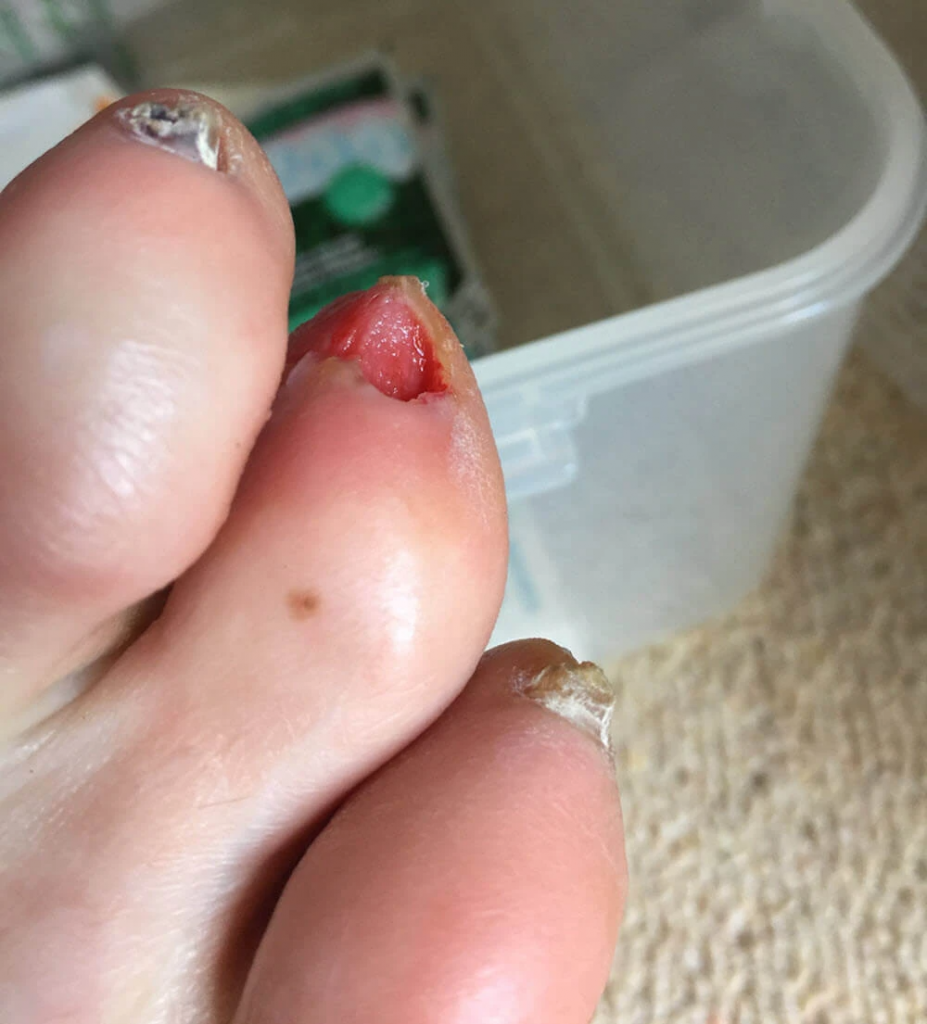 Toenail fallen off nail avulsion toenail blister