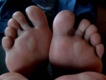 Archeologie Scheiding aantal When Should You Pop A Blister On Your Foot? - Blister Prevention