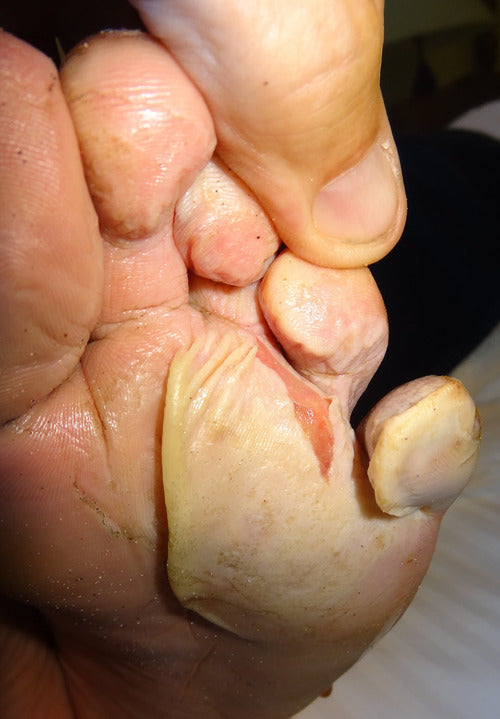 torn macerated skin near toes