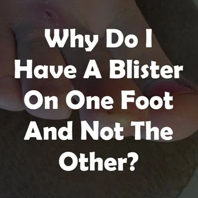 Why do I have a blister on one foot but not the other