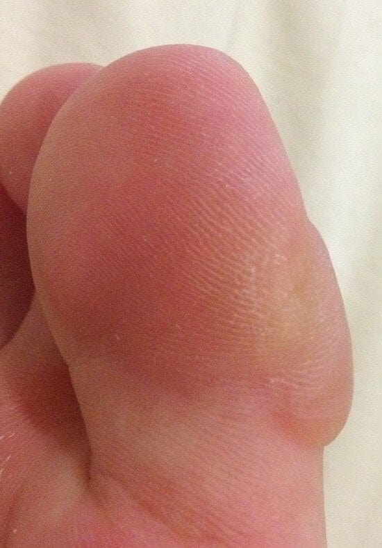 bizon zwaarlijvigheid Verfijning When Should You Pop A Blister On Your Foot? - Blister Prevention