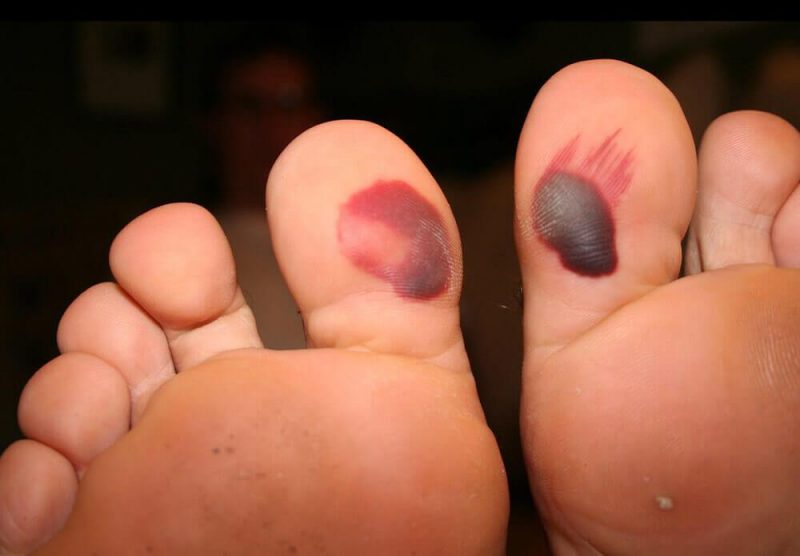 blood blisters under the big toe