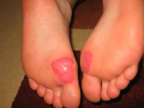 deroofed blisters showing depth of a blister