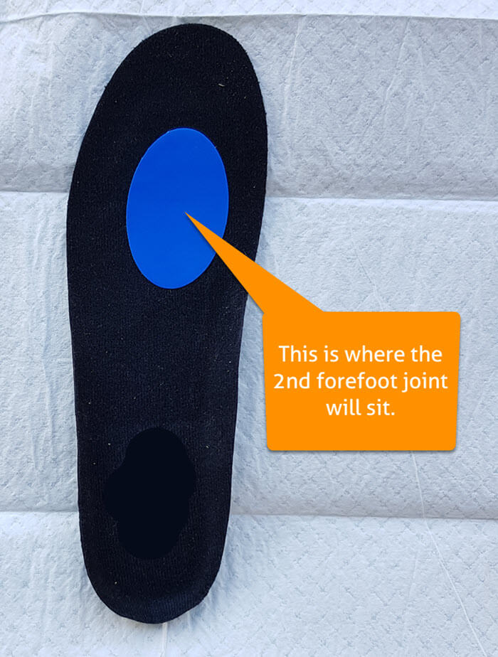 engo patch under 2nd forefoot joint
