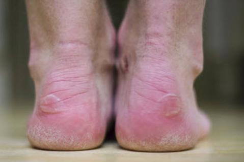 How to treat an intact blister: Your main aim is to protect the blister roof. As long as is intact, it can't get infected. Get rid of blisters on feet by looking at your blister roof.