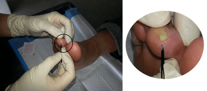 Pus indicated an infected blister