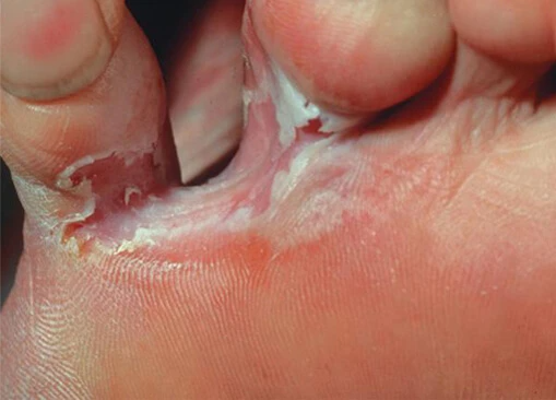 Interdigital athletes foot showing inflamed and peely appearance
