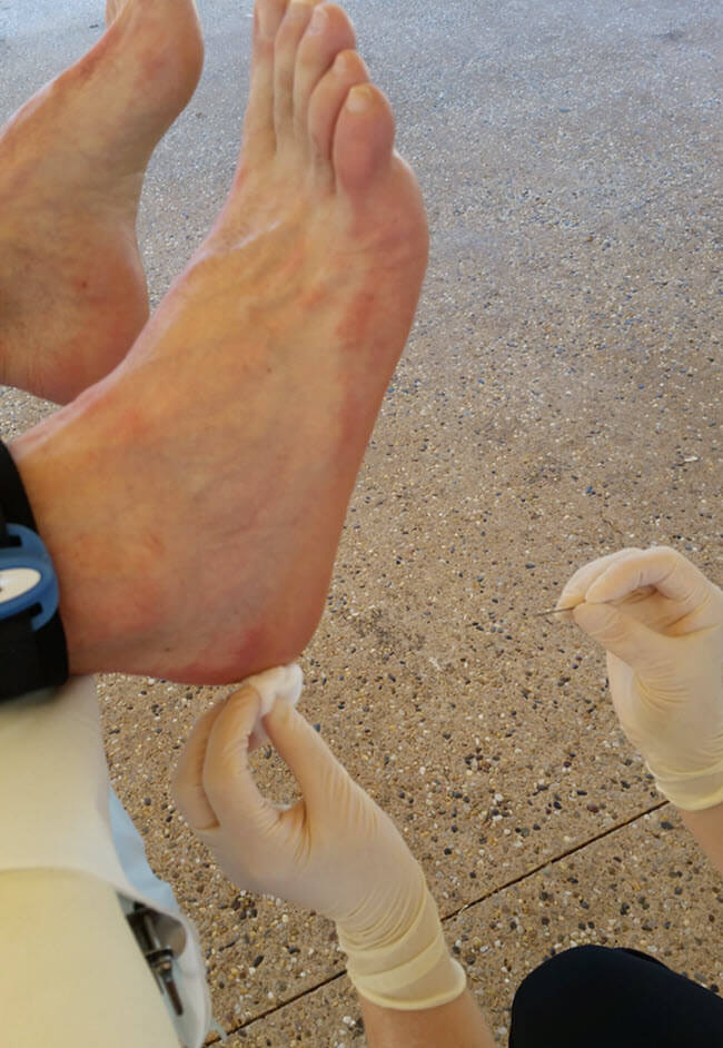 posterior heel edge blisters due to an out-of-place orthotic