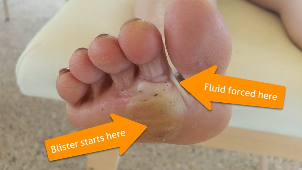 macerated weightbearing ball of foot blister