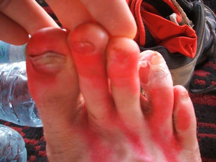 interdigital blister between the toes of a runner