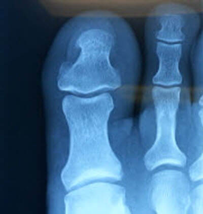 toe bone anatomy and interdigital blisters
