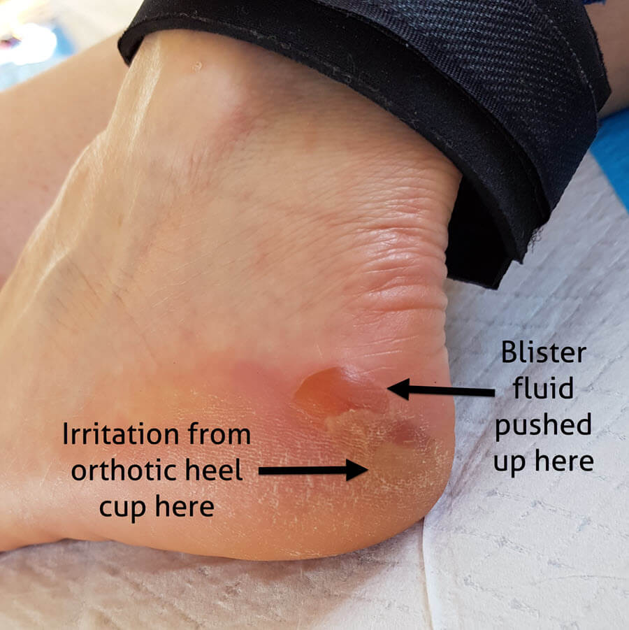 posterior heel edge blisters caused by orthotic sitting out of place