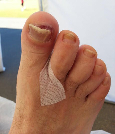 Blood blister under toenail