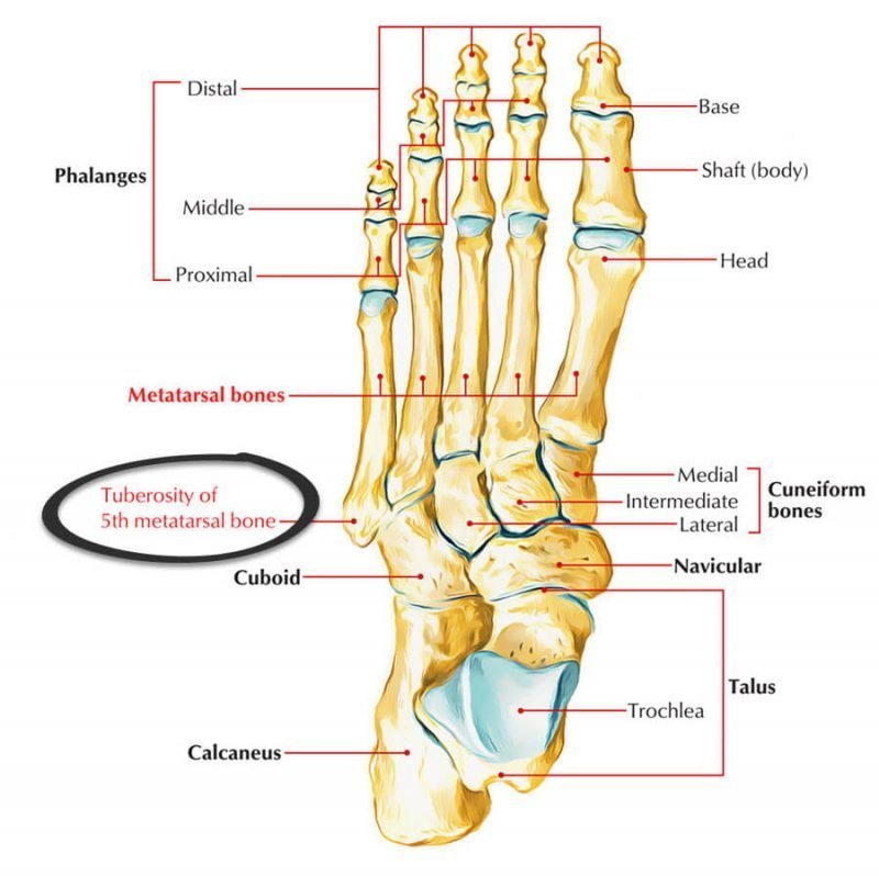 Styloid process blisters occur at the tuberosity of the 5th metatarsal