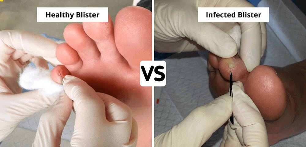 Normal blister fluid is thin and colourless. The blister fluid in an infected blister is thicker and yellow (pus).