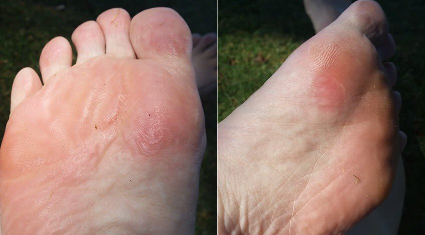 the initial blister injury