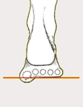orthotic prescription variables for blisters with a plantarflexed first ray