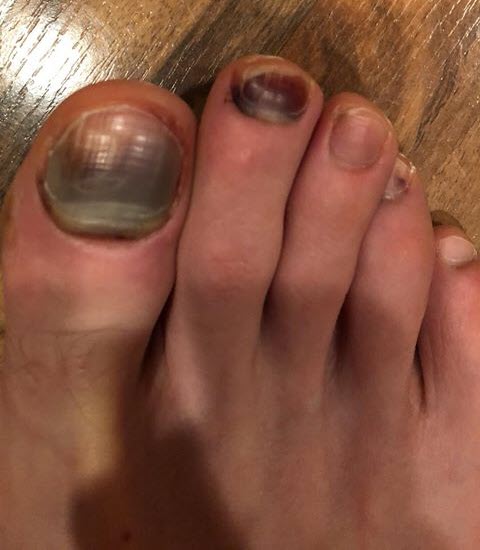 Black toenails from the foot sliding too far forward in the shoe