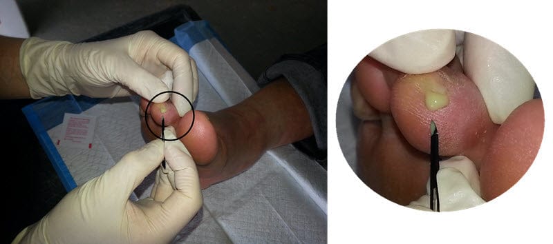 ultra marathon running tip - avoid blister infection