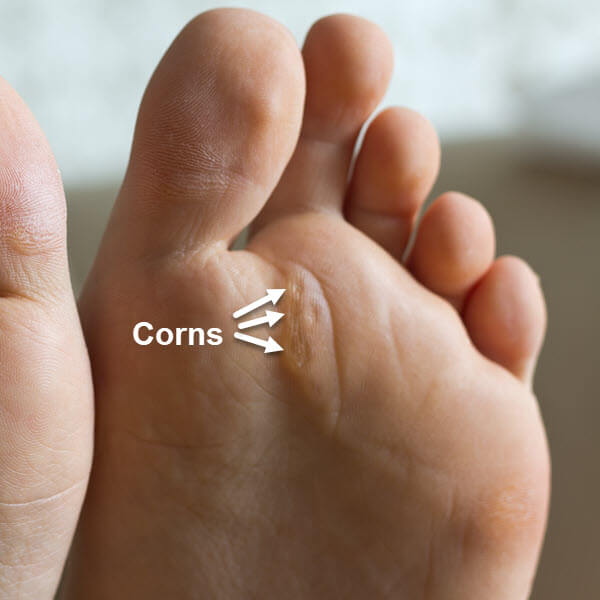 corns of feet under 2nd MPJ