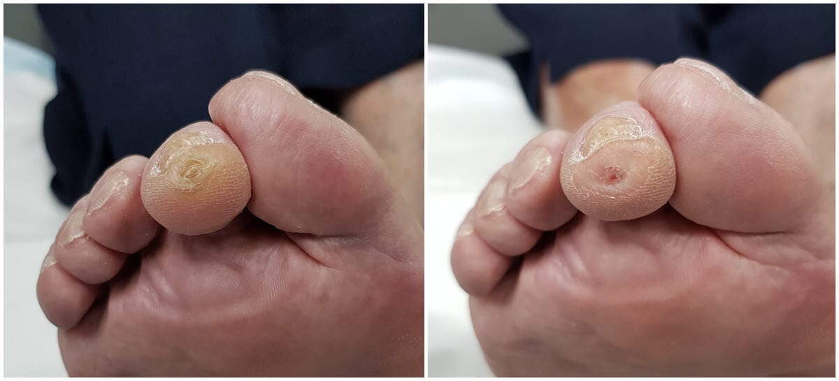 Callous & Corns On Feet: Similarities To Blisters - Blister Prevention