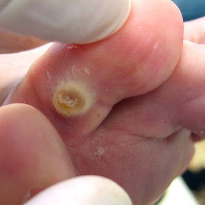 Painful Corn Between Toes Case Study