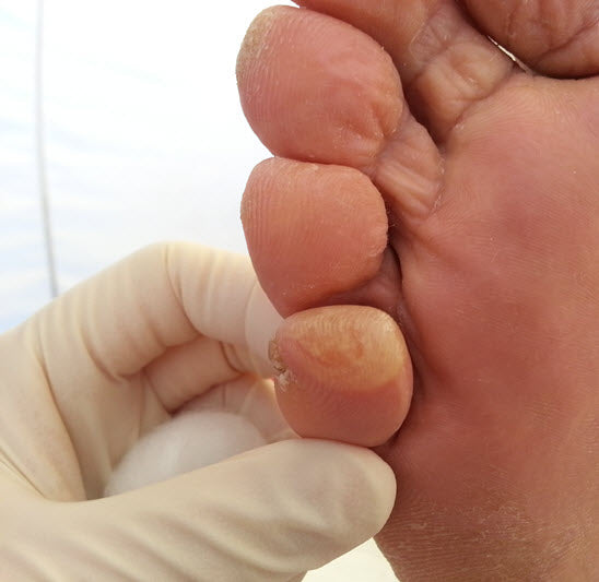 little toe pinch blister Adelaide 2019