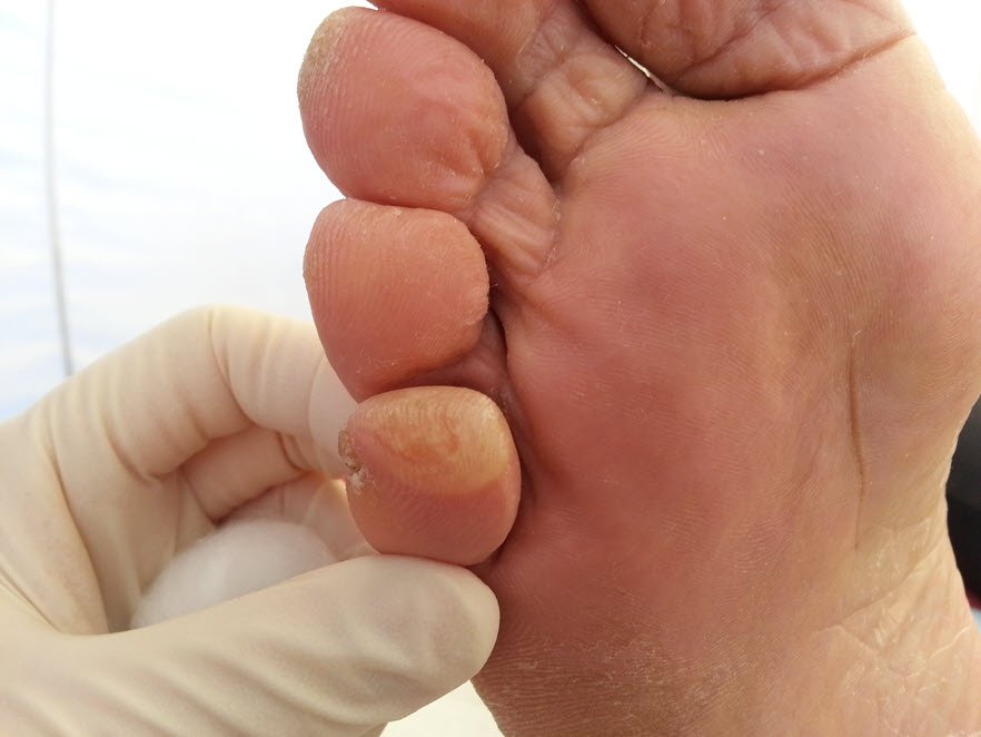 pinch blister 5th toe intact