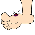 blood blister on foot