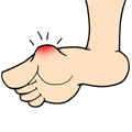 Bunion