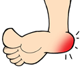 heel blisters