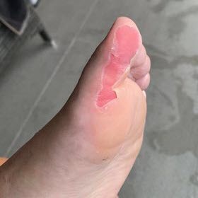 deroofed big toe blisters with football