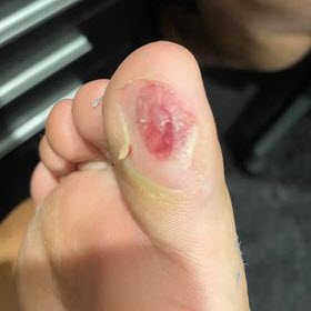 big toe blisters with football