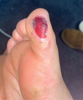 healing big toe blisters with football