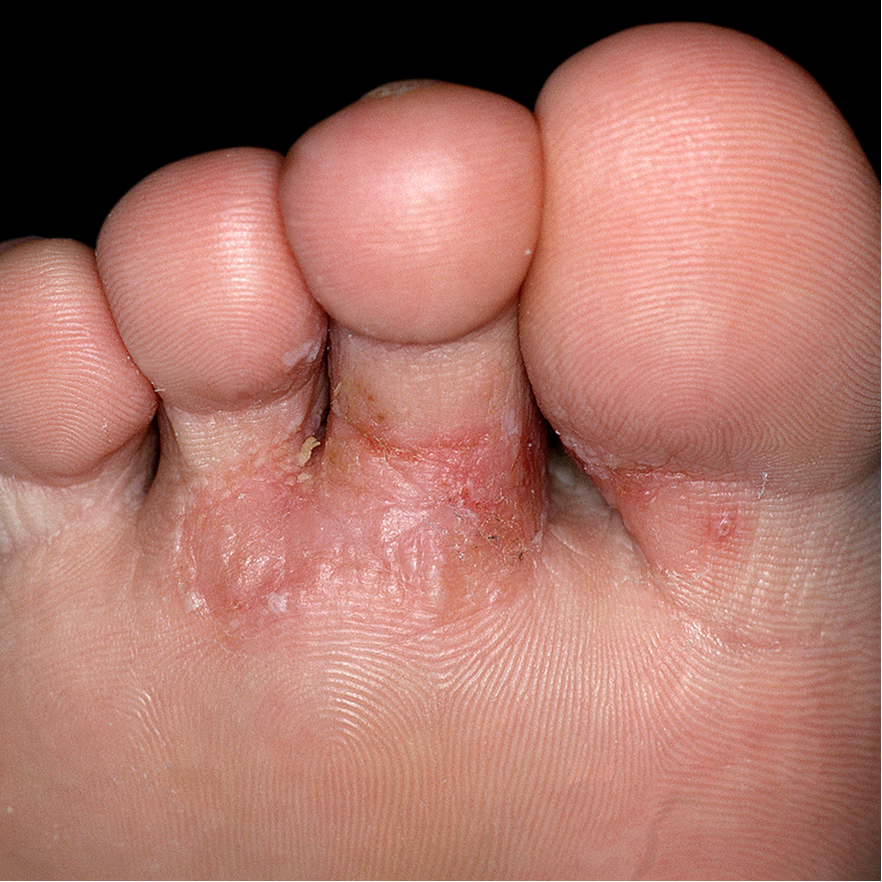 The Many Types and Causes of Foot Blisters