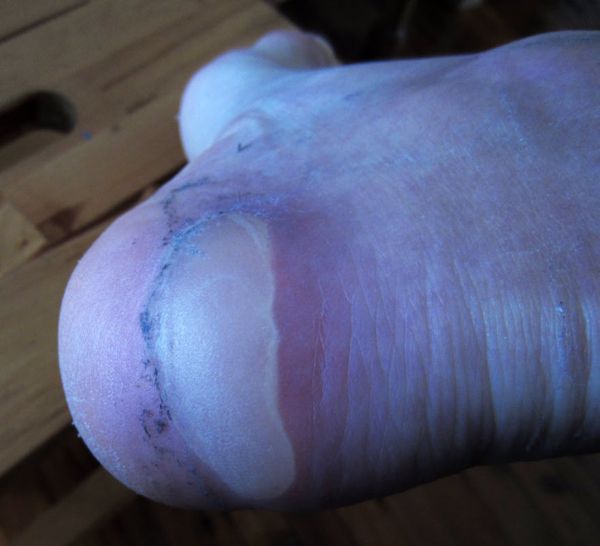 back of heel intact blister Skibug
