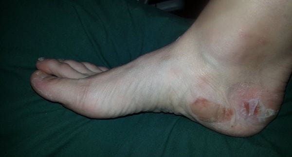 ski boot blisters around the heel and arch